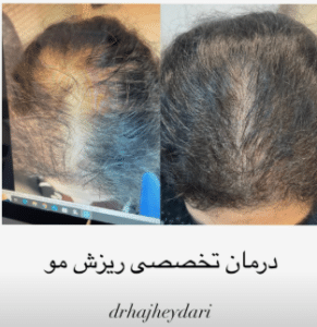 نمونه درمان ریزش مو دکتر زهره حاج حیدری