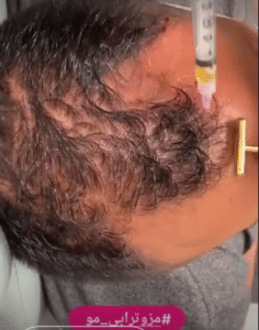 نمونه درمان ریزش مو به روش مزوتراپی دکتر محمدامین صنعتی