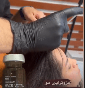 نمونه درمان ریزش مو به روش مزوتراپی دکتر محمدامین صنعتی