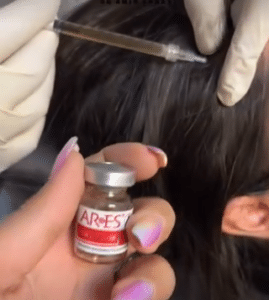 نمونه درمان ریزش مو به روش مزوتراپی دکتر محمدامین صنعتی