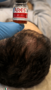 نمونه درمان ریزش مو به روش مزوتراپی دکتر محمدامین صنعتی