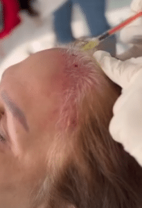 نمونه درمان ریزش مو به روش مزوتراپی دکتر محمدامین صنعتی