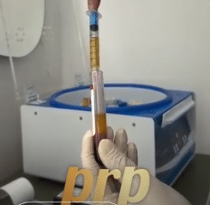 نمونه درمان ریزش مو به روش prp دکتر محمدامین صنعتی