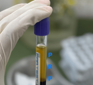 نمونه درمان ریزش مو به روش prp دکتر محمدامین صنعتی