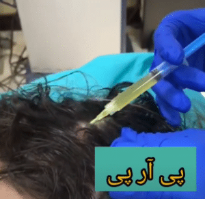 نمونه درمان ریزش مو به روش prp دکتر آسیه صابری