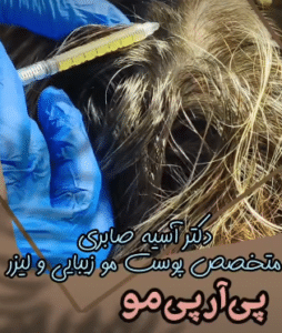نمونه درمان ریزش مو به روش prp دکتر آسیه صابری