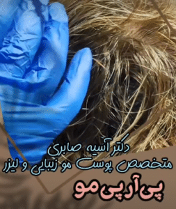 نمونه درمان ریزش مو به روش prp دکتر آسیه صابری