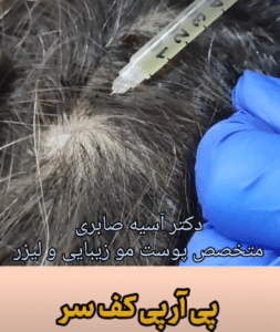 نمونه درمان ریزش مو به روش prp دکتر آسیه صابری