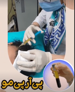 نمونه درمان ریزش مو به روش prp دکتر آسیه صابری