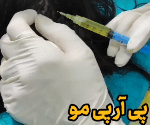نمونه درمان ریزش مو به روش prp دکتر آسیه صابری