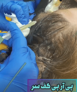 نمونه درمان ریزش مو به روش prp دکتر آسیه صابری