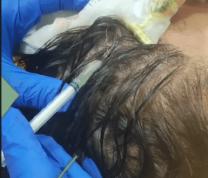 نمونه درمان ریزش مو به روش prp دکتر آسیه صابری