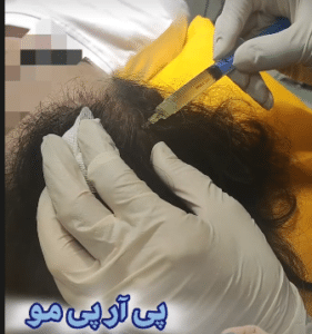 نمونه درمان ریزش مو به روش prp دکتر آسیه صابری