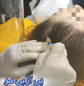 نمونه درمان ریزش مو به روش prp دکتر آسیه صابری
