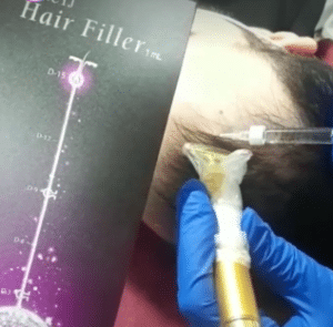 نمونه درمان ریزش مو به روش هیرفیلر دکتر آسیه صابری