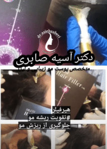 نمونه درمان ریزش مو به روش هیرفیلر دکتر آسیه صابری