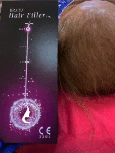 نمونه درمان ریزش مو به روش هیرفیلر دکتر آسیه صابری