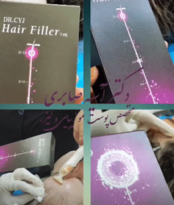 نمونه درمان ریزش مو به روش هیرفیلر دکتر آسیه صابری