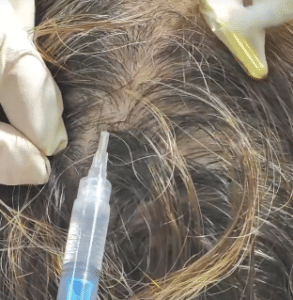 نمونه درمان ریزش مو به روش مزوتراپی دکتر آسیه صابری