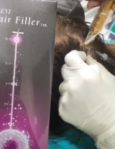 نمونه درمان ریزش مو به روش هیرفیلر دکتر آسیه صابری