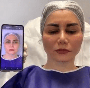 نمونه لیفت با نخ دکتر حسین خسروی