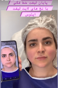 نمونه لیفت با نخ دکتر حسین خسروی