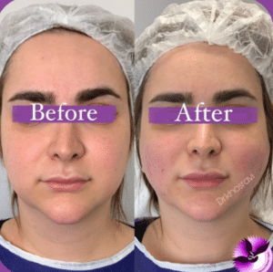 نمونه لیفت با نخ دکتر حسین خسروی