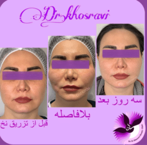 نمونه لیفت با نخ دکتر حسین خسروی