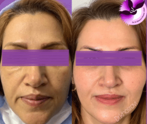 نمونه لیفت با نخ دکتر حسین خسروی