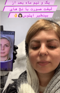 نمونه لیفت با نخ دکتر حسین خسروی