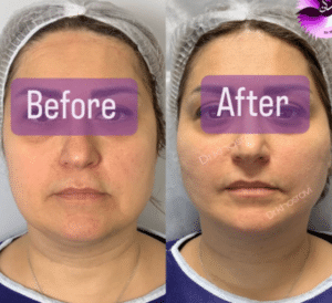 نمونه لیفت با نخ دکتر حسین خسروی