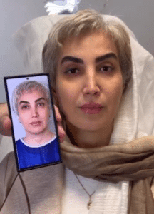 نمونه لیفت با نخ دکتر حسین خسروی