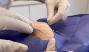 نمونه لیفت با نخ دکتر حسین خسروی