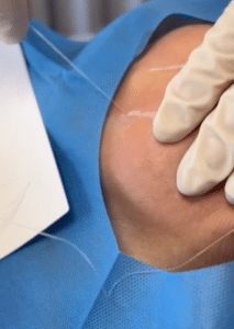 نمونه لیفت با نخ دکتر حسین خسروی