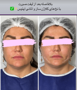 نمونه لیفت با نخ دکتر حسین خسروی