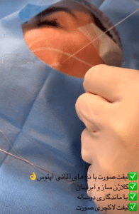 نمونه لیفت با نخ دکتر حسین خسروی