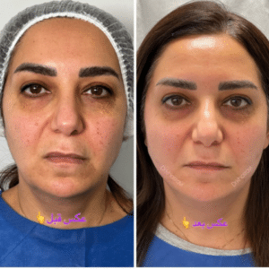 نمونه لیفت با نخ دکتر حسین خسروی