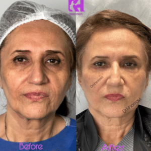 نمونه لیفت با نخ دکتر حسین خسروی