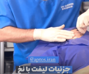 نمونه لیفت با نخ دکتر حسین خسروی