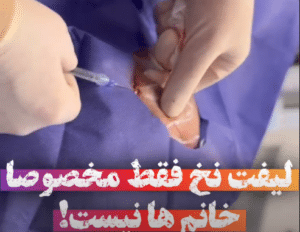 نمونه لیفت با نخ دکتر حسین خسروی