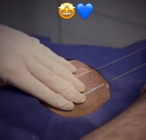 نمونه لیفت با نخ دکتر حسین خسروی