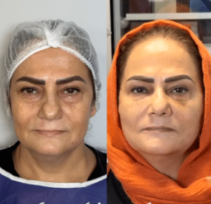 نمونه لیفت با نخ دکتر حسین خسروی