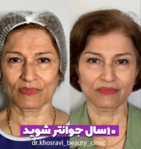 نمونه لیفت با نخ دکتر حسین خسروی