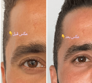 نمونه لیفت با نخ دکتر حسین خسروی