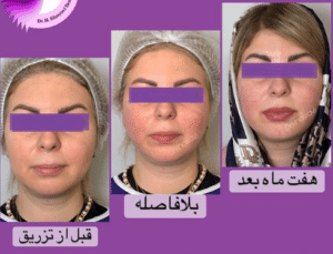 نمونه لیفت با نخ دکتر حسین خسروی
