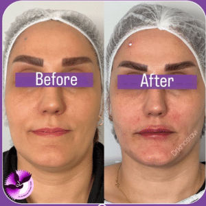 نمونه لیفت با نخ دکتر حسین خسروی