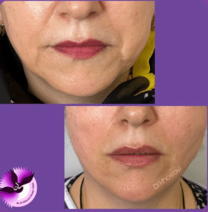 نمونه لیفت با نخ دکتر حسین خسروی