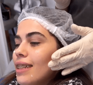 نمونه لیفت با نخ دکتر حسین خسروی