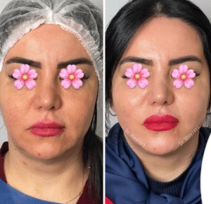 نمونه لیفت با نخ دکتر حسین خسروی