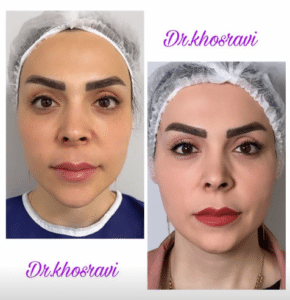 نمونه لیفت با نخ دکتر حسین خسروی